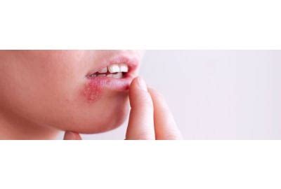 Herpes genital: transmitere, simptome, tratament si complicatii